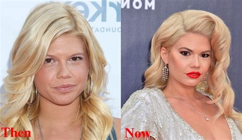 Chanel West Coast Plastic Surgery Before and After